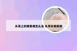 头发上的银屑病怎么治 头发长银屑病