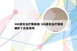 308激光治疗银屑病 308激光治疗银屑病好了还复发吗