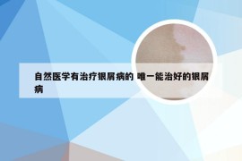 自然医学有治疗银屑病的 唯一能治好的银屑病