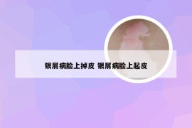 银屑病脸上掉皮 银屑病脸上起皮