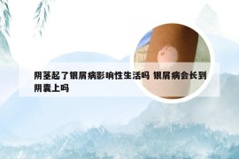 阴茎起了银屑病影响性生活吗 银屑病会长到阴囊上吗