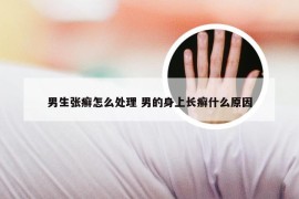 男生张癣怎么处理 男的身上长癣什么原因