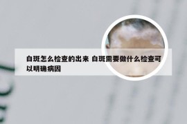 白斑怎么检查的出来 白斑需要做什么检查可以明确病因