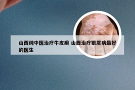 山西纯中医治疗牛皮癣 山西治疗银屑病最好的医生