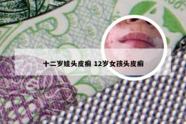 十二岁娃头皮癣 12岁女孩头皮癣