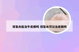 双氧水能治牛皮癣吗 双氧水可以治皮癣吗