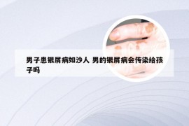 男子患银屑病如沙人 男的银屑病会传染给孩子吗