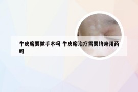 牛皮廨要做手术吗 牛皮廨治疗需要终身用药吗