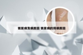 银屑病发病原因 银屑病的得病原因