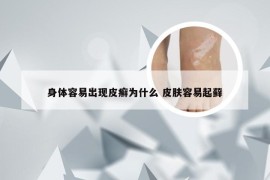 身体容易出现皮癣为什么 皮肤容易起藓