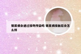 银屑病会通过接吻传染吗 银屑病接触后会怎么样