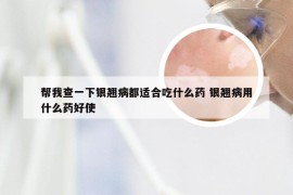 帮我查一下银翘病都适合吃什么药 银翘病用什么药好使