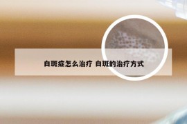 白斑症怎么治疗 白斑的治疗方式