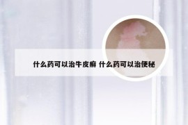 什么药可以治牛皮癣 什么药可以治便秘