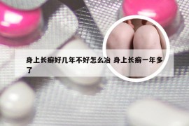 身上长癣好几年不好怎么冶 身上长癣一年多了