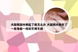 大腿根部内侧起了癣怎么办 大腿根内侧长了一些像癣一样的不疼不痒