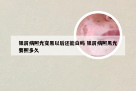 银屑病照光变黑以后还能白吗 银屑病照黑光要照多久