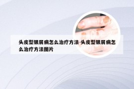 头皮型银屑病怎么治疗方法 头皮型银屑病怎么治疗方法图片