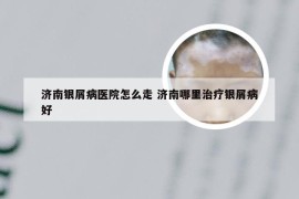 济南银屑病医院怎么走 济南哪里治疗银屑病好