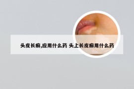 头皮长癣,应用什么药 头上长皮癣用什么药