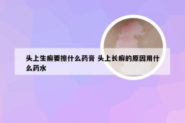 头上生癣要擦什么药膏 头上长癣的原因用什么药水