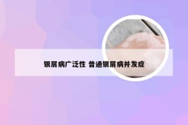 银屑病广泛性 普通银屑病并发症