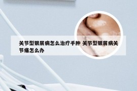 关节型银屑病怎么治疗手肿 关节型银屑病关节痛怎么办