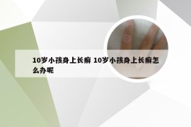 10岁小孩身上长癣 10岁小孩身上长癣怎么办呢