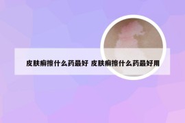 皮肤癣擦什么药最好 皮肤癣擦什么药最好用