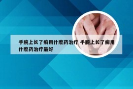 手腕上长了癣用什麽药治疗 手腕上长了癣用什麽药治疗最好