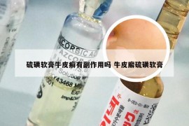 硫磺软膏牛皮癣有副作用吗 牛皮廨硫磺软膏