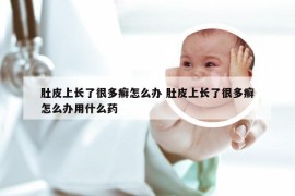 肚皮上长了很多癣怎么办 肚皮上长了很多癣怎么办用什么药