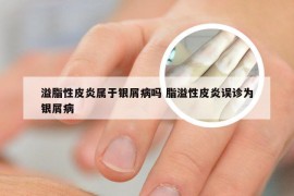 溢脂性皮炎属于银屑病吗 脂溢性皮炎误诊为银屑病