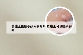 皮康王能给小孩头癣用吗 皮康王可以擦头癣吗