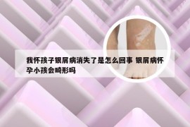 我怀孩子银屑病消失了是怎么回事 银屑病怀孕小孩会畸形吗