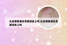 头皮银屑病会发展到身上吗 头皮银屑病会发展到身上吗