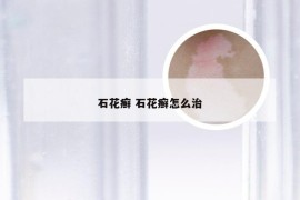 石花癣 石花癣怎么治