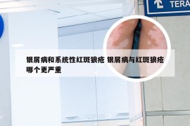 银屑病和系统性红斑狼疮 银屑病与红斑狼疮哪个更严重