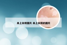 身上白斑图片 身上白斑的图片