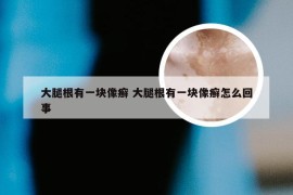 大腿根有一块像癣 大腿根有一块像癣怎么回事