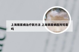 上海银屑病治疗新方法 上海银屑病医院可靠吗