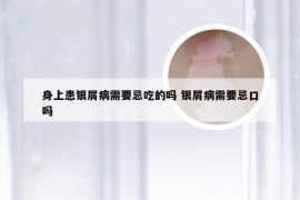 身上患银屑病需要忌吃的吗 银屑病需要忌口吗