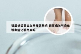 银屑病关节炎血常规正常吗 银屑病关节炎化验血能化验出来吗