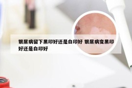 银屑病留下黑印好还是白印好 银屑病变黑印好还是白印好