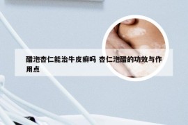 醋泡杏仁能治牛皮癣吗 杏仁泡醋的功效与作用点