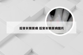 后背长银屑病 后背长银屑病图片