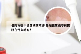 贵阳市哪个银屑病医院好 贵阳银屑病专科医院在什么地方?