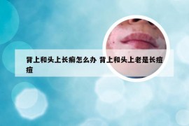 背上和头上长癣怎么办 背上和头上老是长痘痘