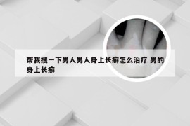 帮我搜一下男人男人身上长癣怎么治疗 男的身上长癣