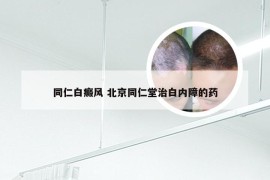 同仁白癜风 北京同仁堂治白内障的药